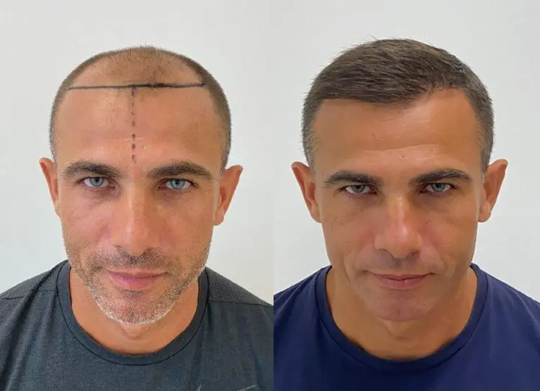 Hair transplant before and after results